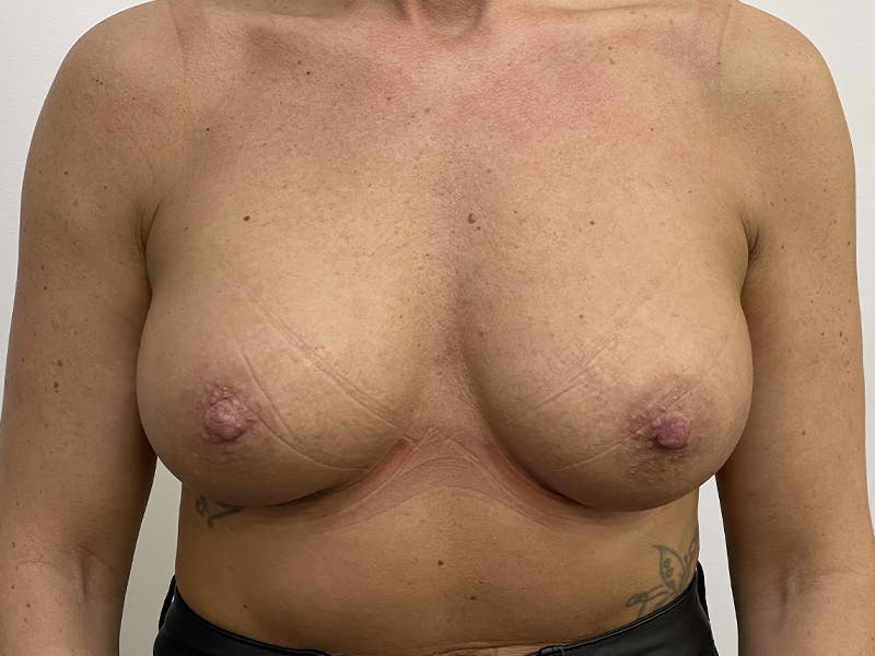 Breast Augmentation Before & After Gallery - Patient 121144508 - Image 2