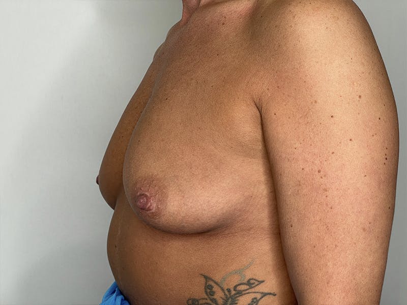 Breast Augmentation Before & After Gallery - Patient 121144508 - Image 3