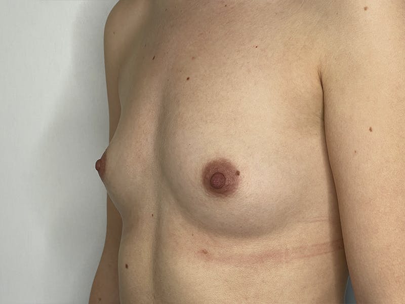 Breast Augmentation Before & After Gallery - Patient 121144511 - Image 1