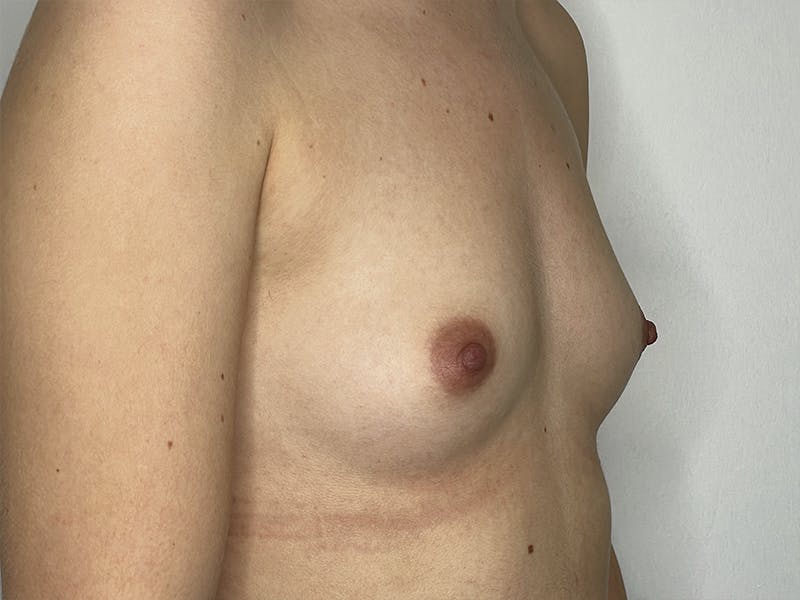 Breast Augmentation Before & After Gallery - Patient 121144511 - Image 3