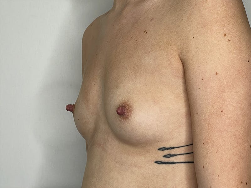 Breast Augmentation Before & After Gallery - Patient 121144512 - Image 1