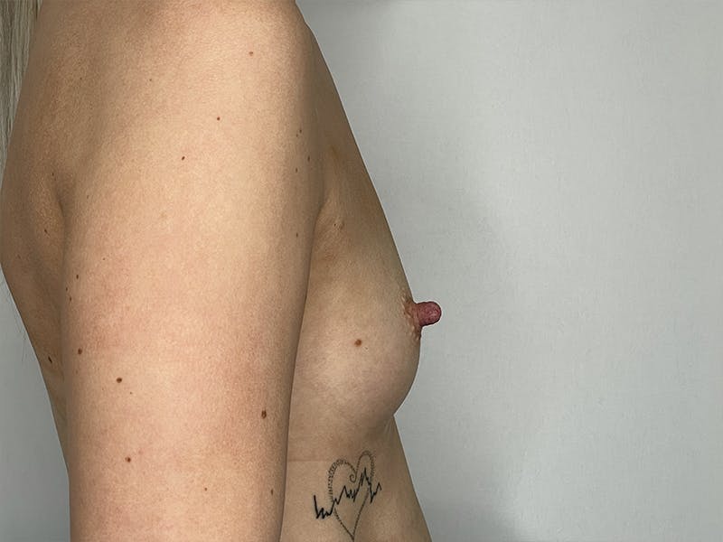 Breast Augmentation Before & After Gallery - Patient 121144512 - Image 3