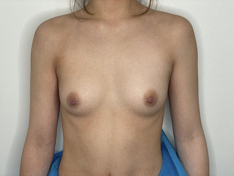 Breast Augmentation Before & After Gallery - Patient 121144513 - Image 1