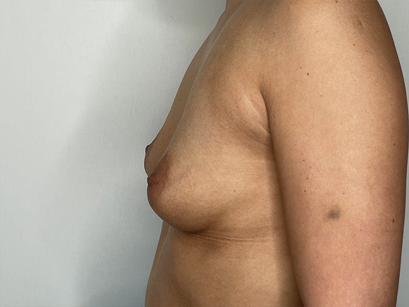 Breast Augmentation Before & After Gallery - Patient 121144514 - Image 1