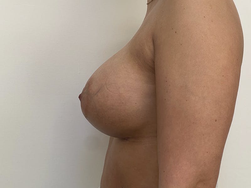 Breast Augmentation Before & After Gallery - Patient 121144514 - Image 2