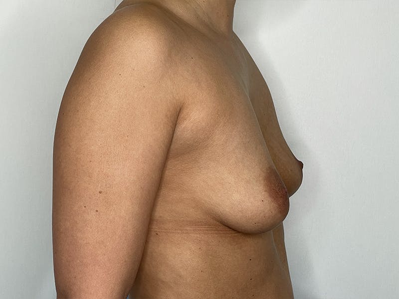 Breast Augmentation Before & After Gallery - Patient 121144514 - Image 3