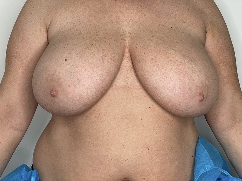Breast Reduction  Before & After Gallery - Patient 121144526 - Image 1