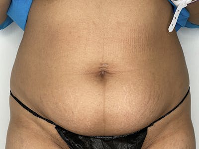 Tummy Tuck Before & After Gallery - Patient 121144554 - Image 1