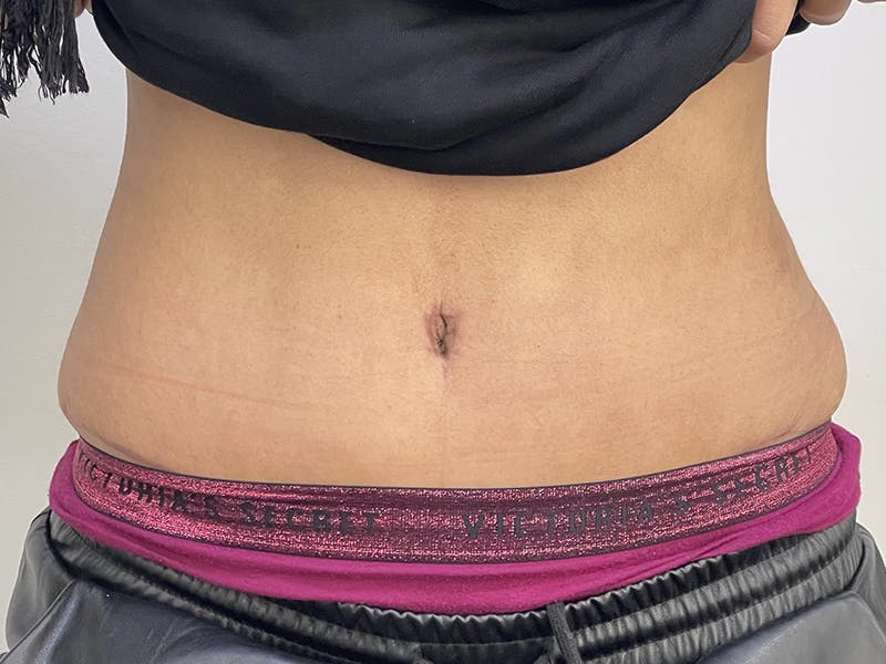 Tummy Tuck Before & After Gallery - Patient 121144554 - Image 2