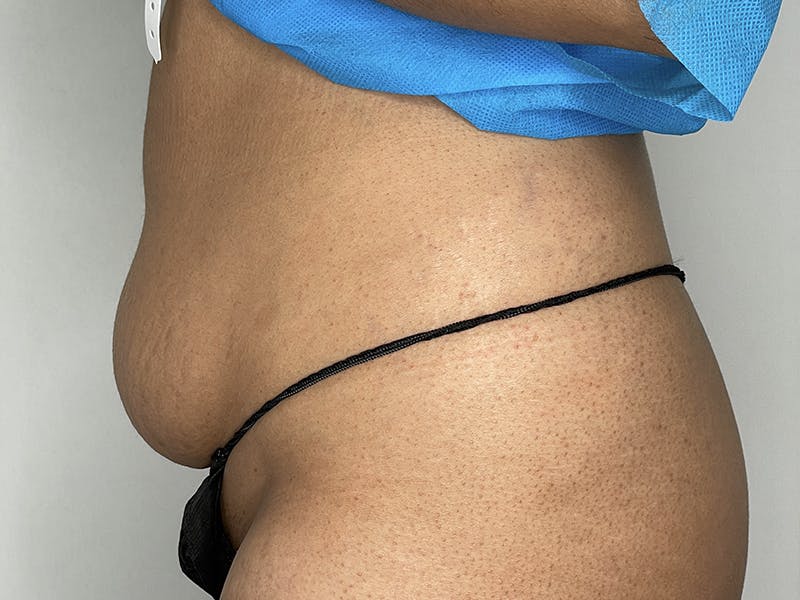Tummy Tuck Before & After Gallery - Patient 121144554 - Image 3