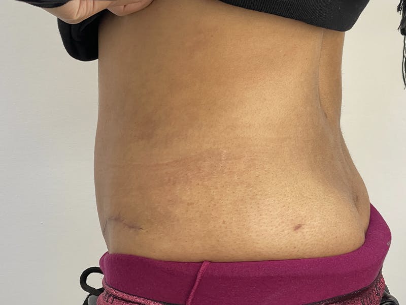 Tummy Tuck Before & After Gallery - Patient 121144554 - Image 4