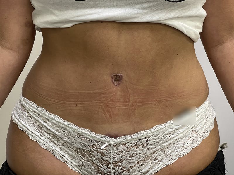 Liposuction Before & After Gallery - Patient 121144596 - Image 2