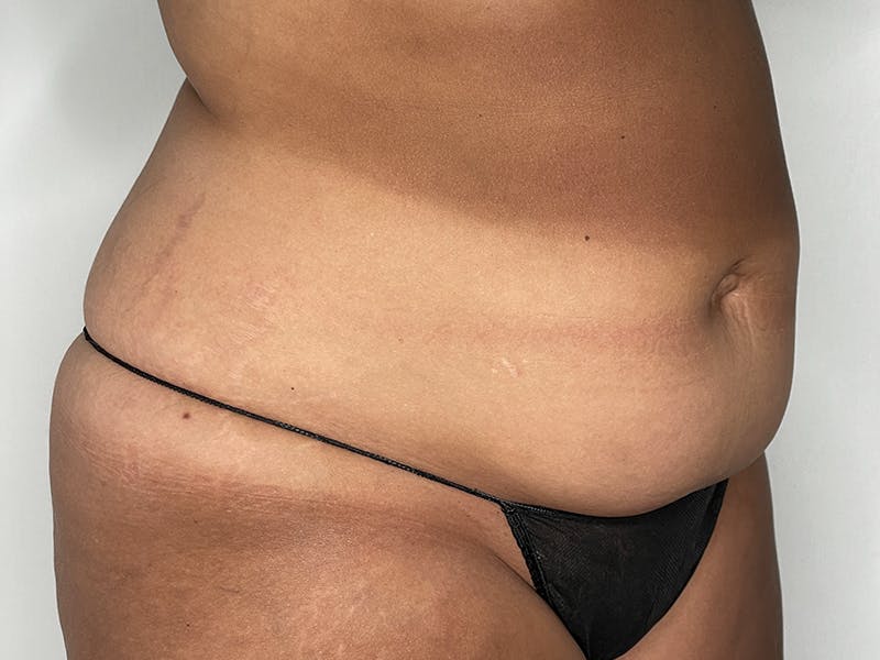 Liposuction Before & After Gallery - Patient 121144596 - Image 3