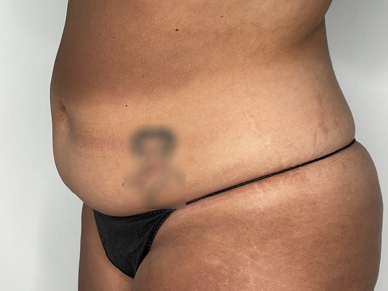 Liposuction Before & After Gallery - Patient 121144596 - Image 5