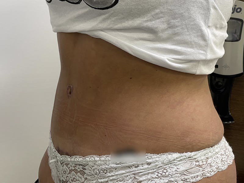 Liposuction Before & After Gallery - Patient 121144596 - Image 6