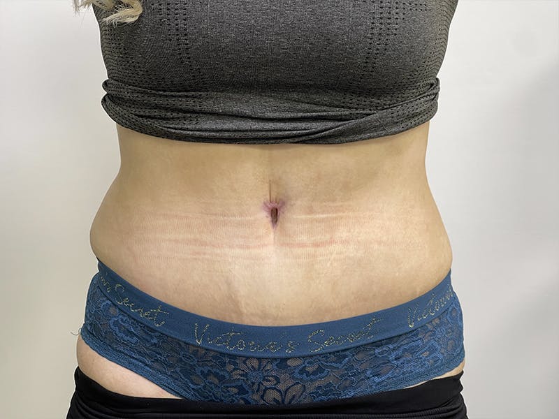 Tummy Tuck Before & After Gallery - Patient 121144573 - Image 2