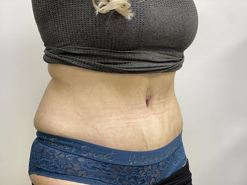 Liposuction Before & After Gallery - Patient 121144597 - Image 4