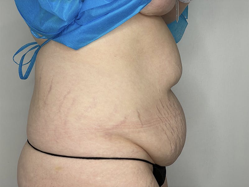 Tummy Tuck Before & After Gallery - Patient 121144573 - Image 5