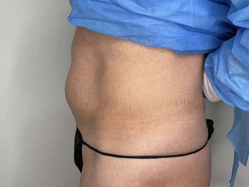 Liposuction Before & After Gallery - Patient 121144598 - Image 1