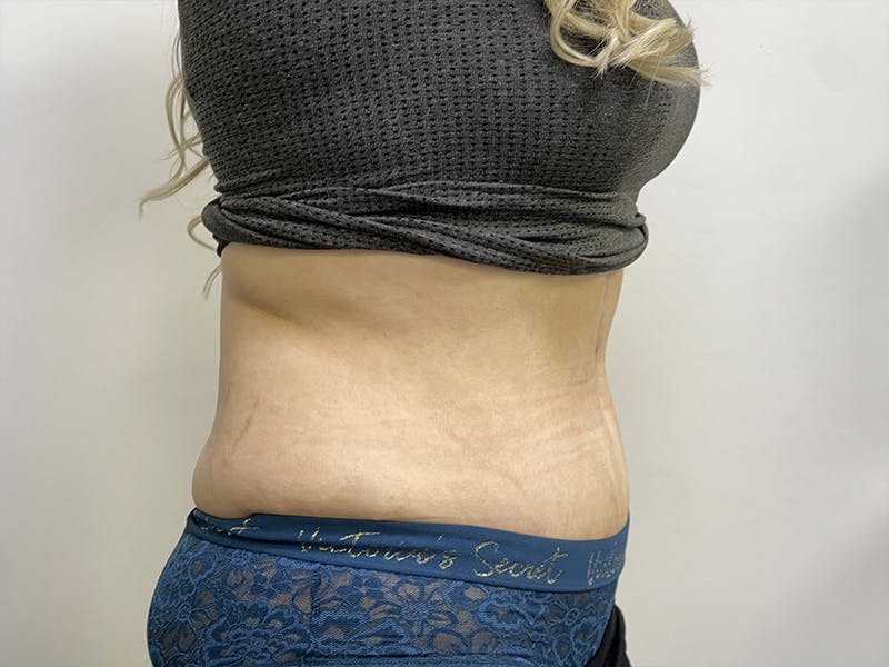 Liposuction Before & After Gallery - Patient 121144597 - Image 6