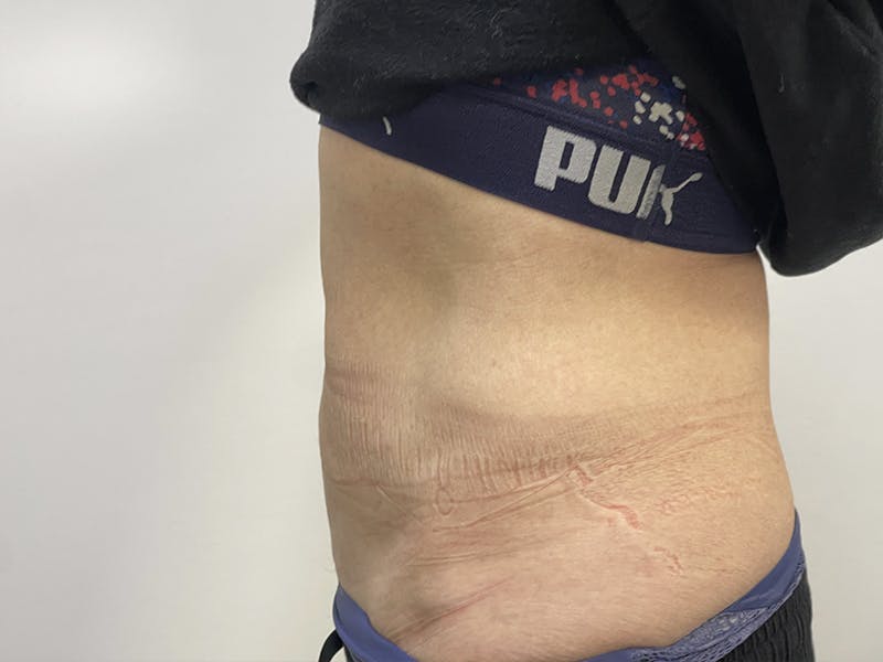 Tummy Tuck Before & After Gallery - Patient 121144574 - Image 2