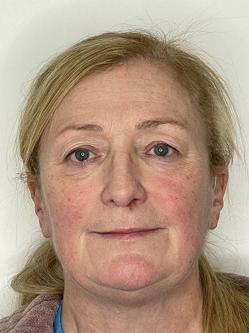 Eyelid Surgery Before & After Gallery - Patient 121144611 - Image 1