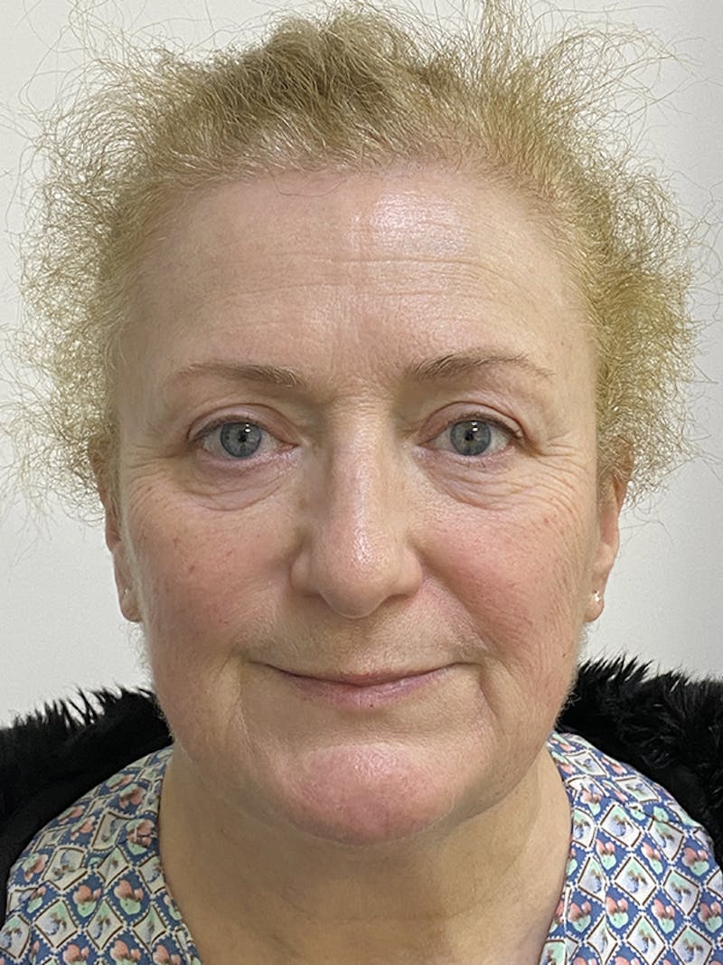Eyelid Surgery Before & After Gallery - Patient 121144611 - Image 2