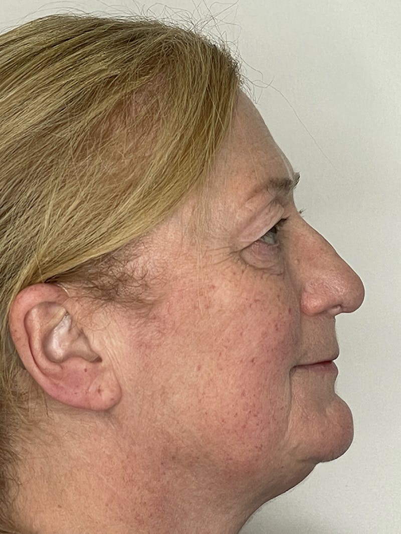 Eyelid Surgery Before & After Gallery - Patient 121144611 - Image 3