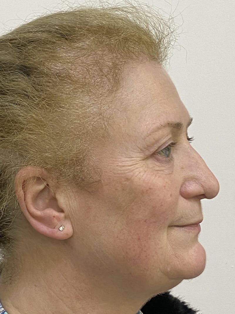 Eyelid Surgery Before & After Gallery - Patient 121144611 - Image 4