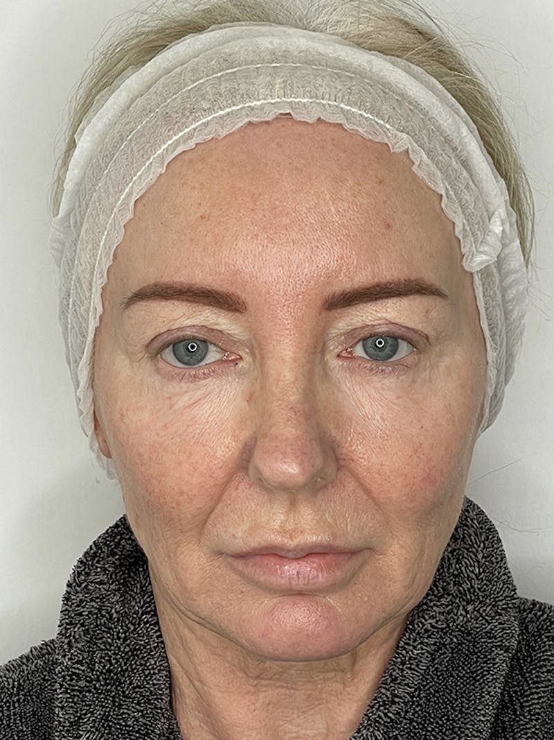 Facelift Before & After Gallery - Patient 121144653 - Image 1