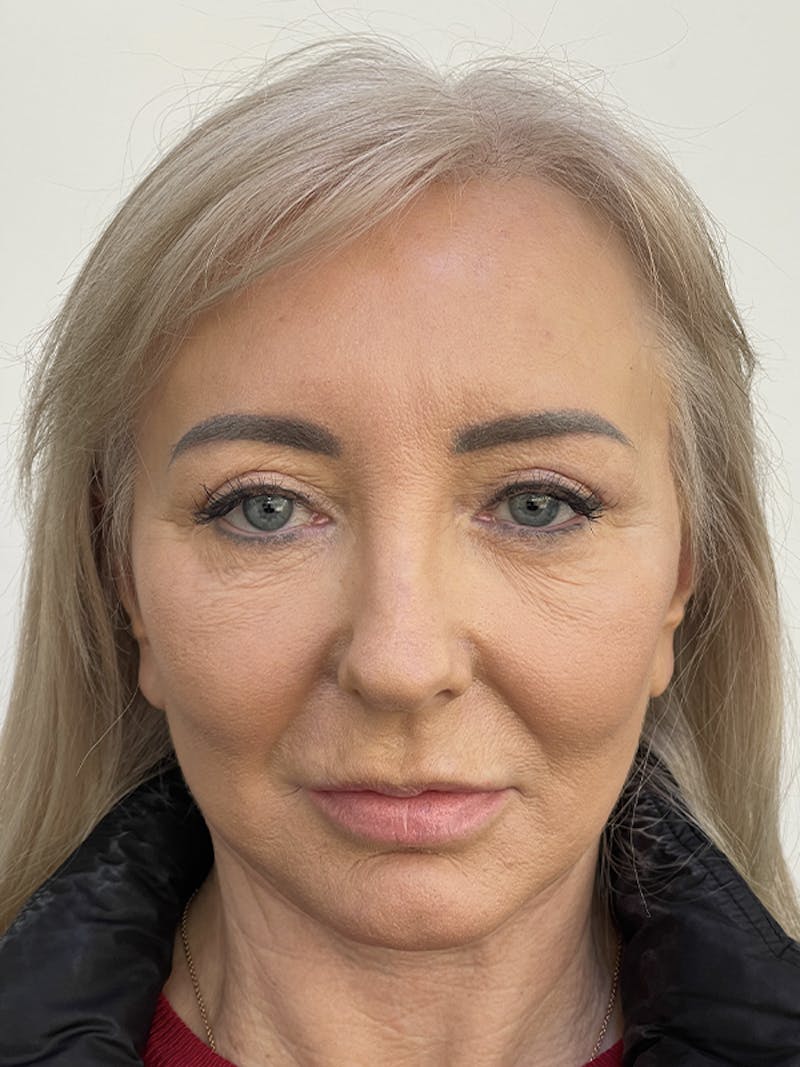 Facelift Before & After Gallery - Patient 121144653 - Image 2