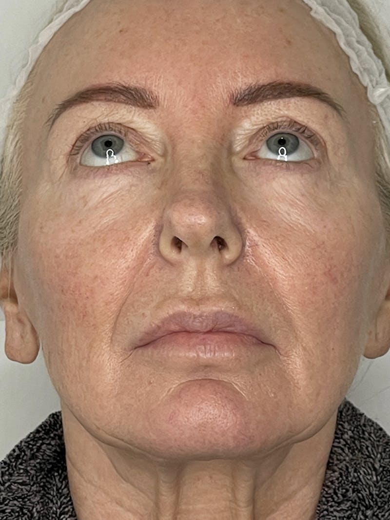 Facelift Before & After Gallery - Patient 121144653 - Image 3