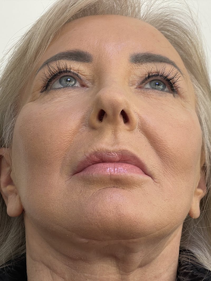 Facelift Before & After Gallery - Patient 121144653 - Image 4