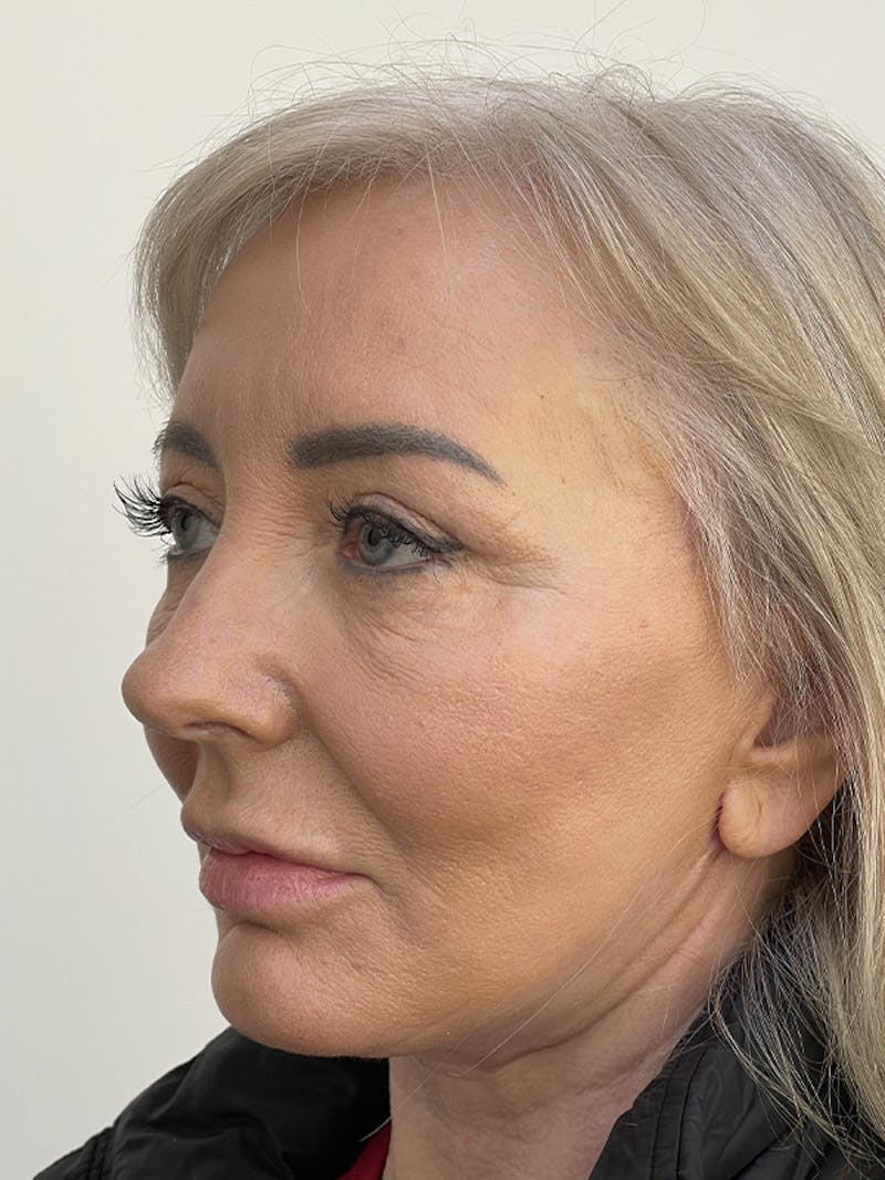 Facelift Before & After Gallery - Patient 121144653 - Image 6