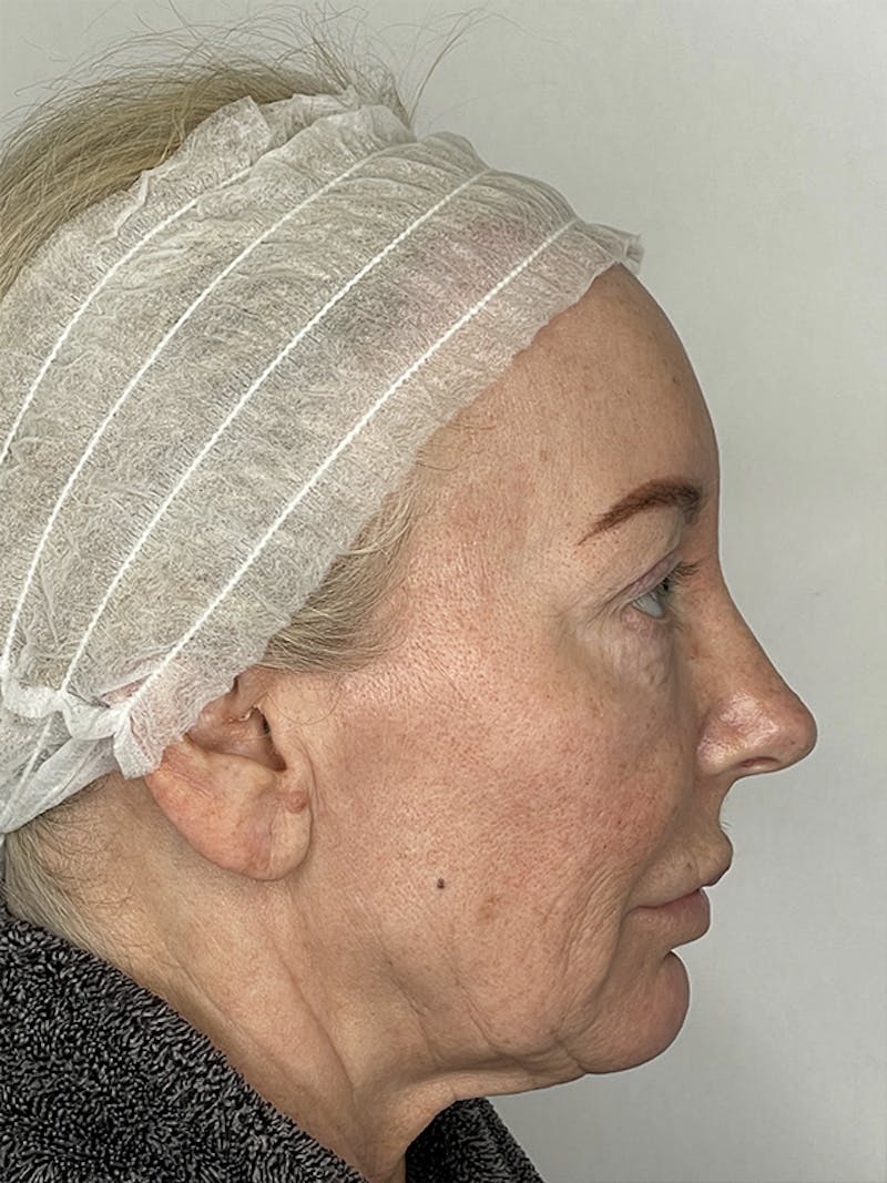 Facelift Before & After Gallery - Patient 121144653 - Image 7