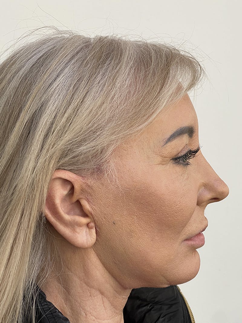 Facelift Before & After Gallery - Patient 121144653 - Image 8