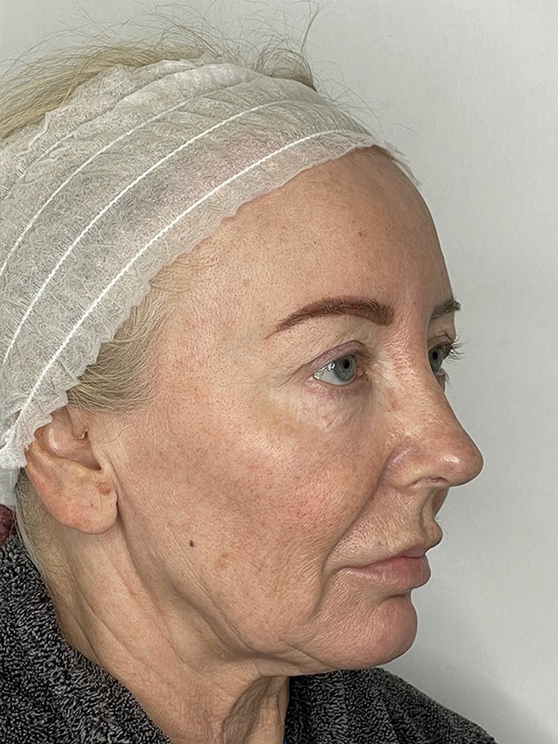 Facelift Before & After Gallery - Patient 121144653 - Image 9