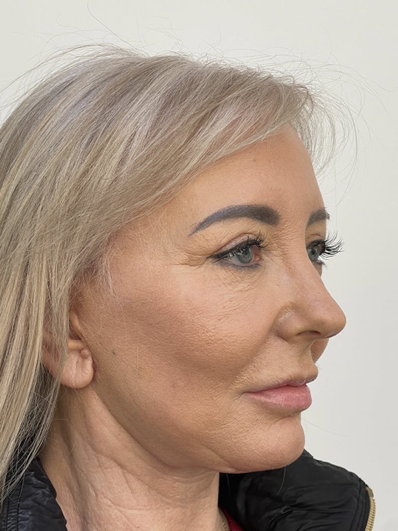 Facelift Before & After Gallery - Patient 121144653 - Image 10