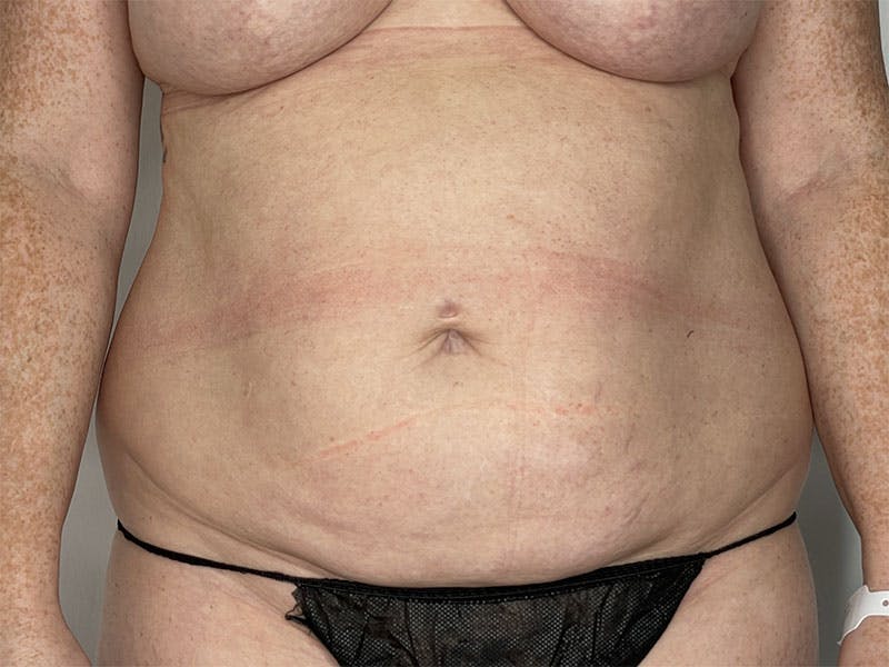 Tummy Tuck Before & After Gallery - Patient 122371043 - Image 1