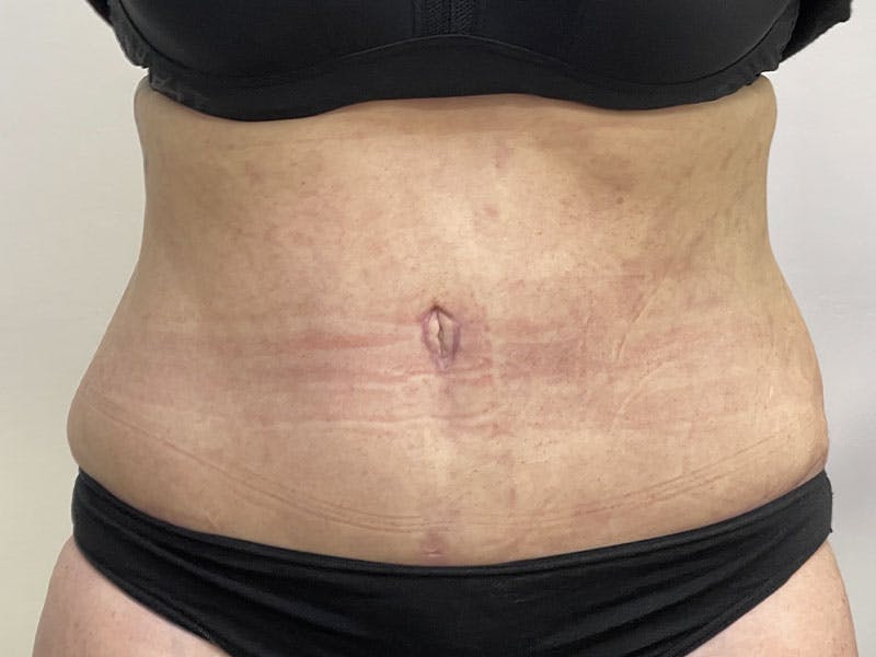Tummy Tuck Before & After Gallery - Patient 122371043 - Image 2