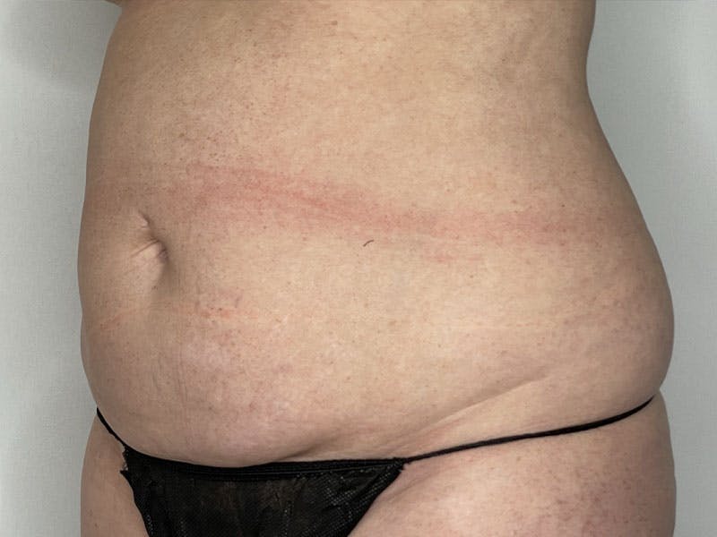 Tummy Tuck Before & After Gallery - Patient 122371043 - Image 3