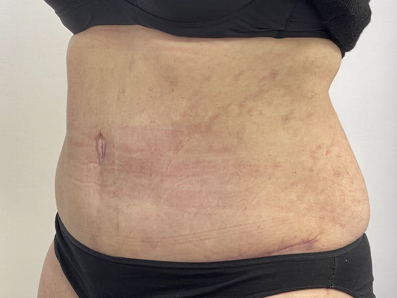 Tummy Tuck Before & After Gallery - Patient 122371043 - Image 4