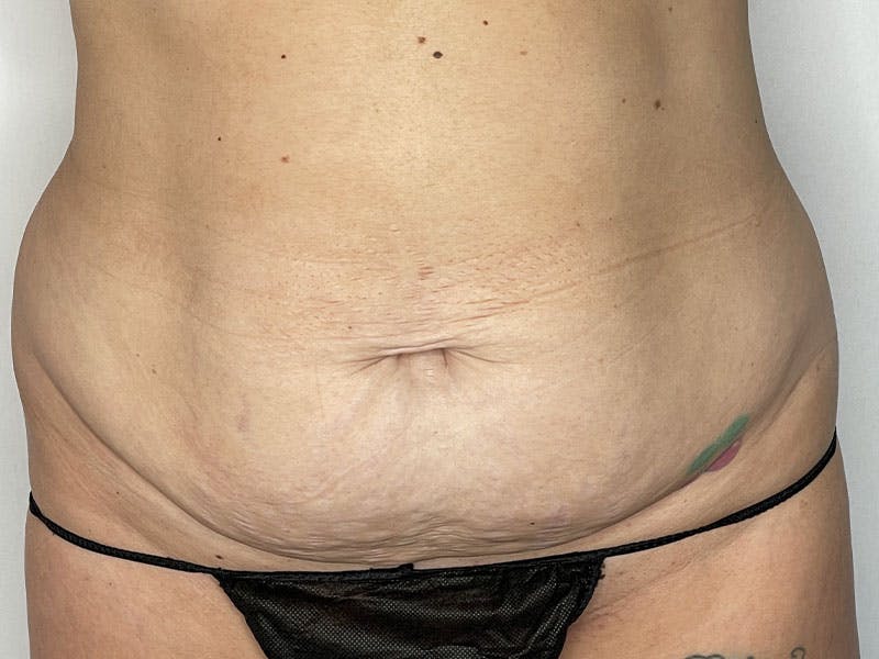 Tummy Tuck Before & After Gallery - Patient 122371044 - Image 1
