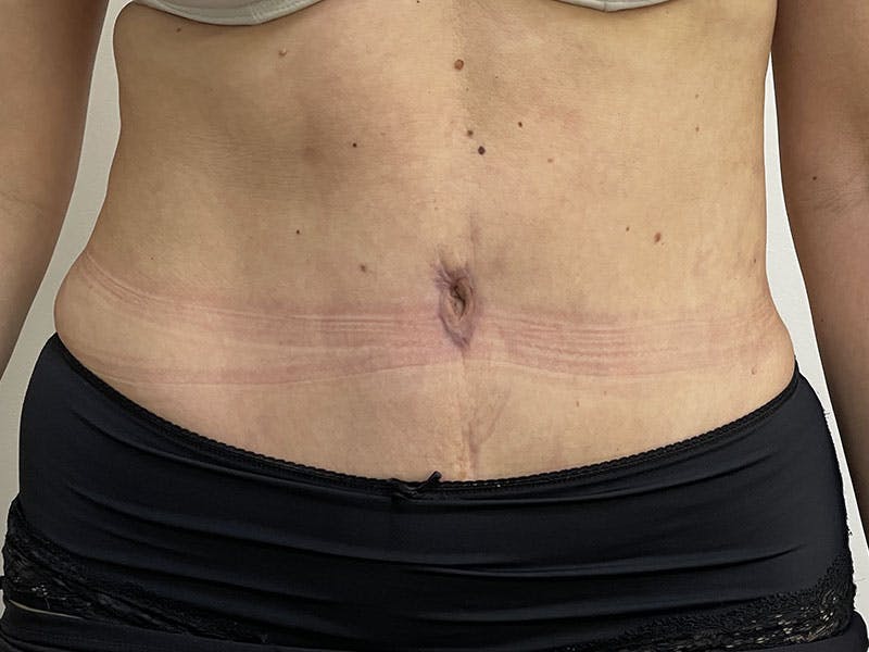 Tummy Tuck Before & After Gallery - Patient 122371044 - Image 2