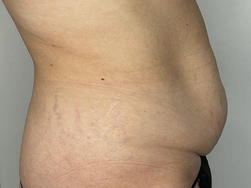 Liposuction Before & After Gallery - Patient 122371048 - Image 3
