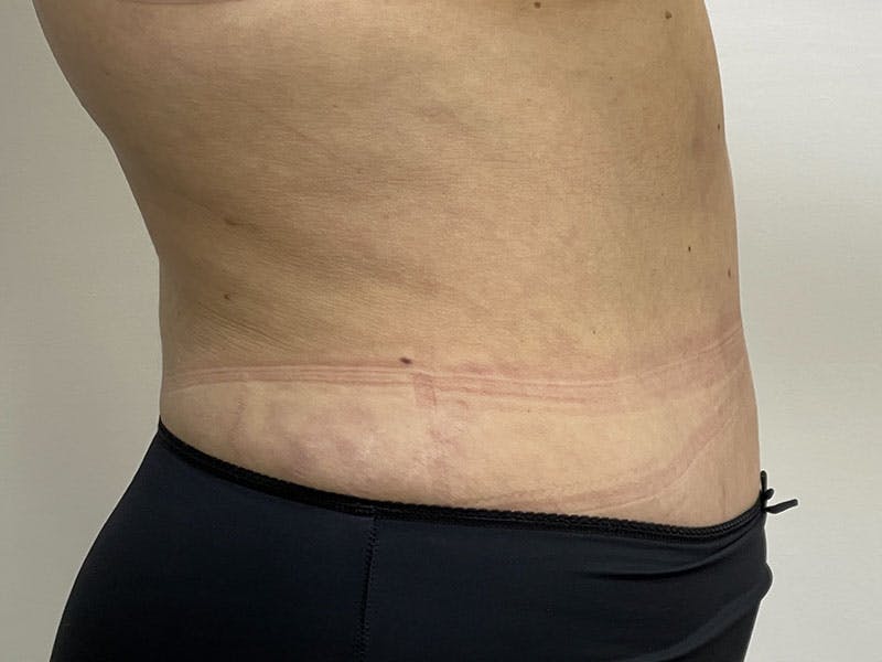 Liposuction Before & After Gallery - Patient 122371048 - Image 4