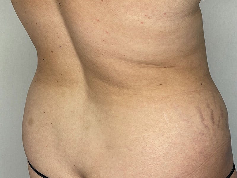 Tummy Tuck Before & After Gallery - Patient 122371044 - Image 5