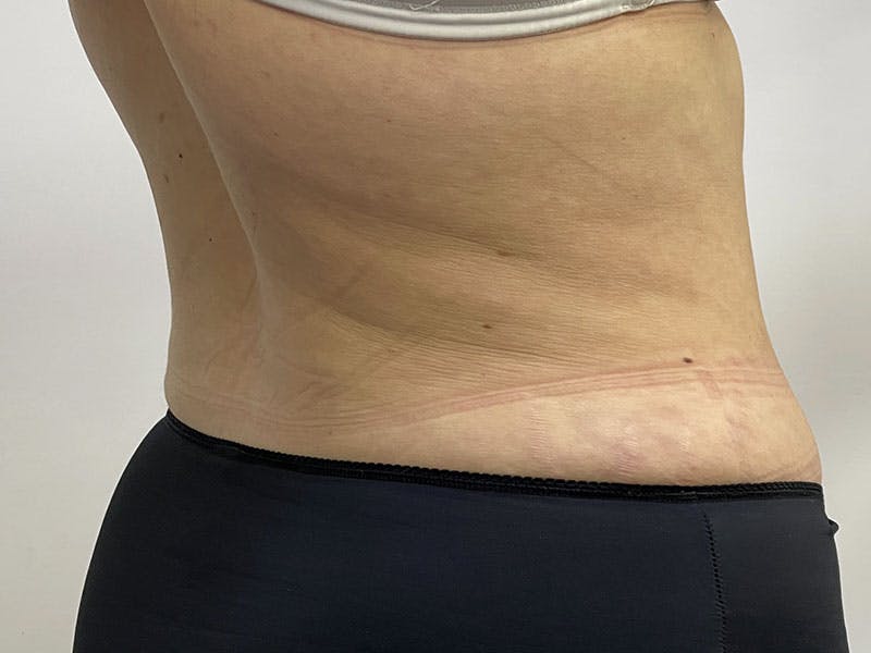 Liposuction Before & After Gallery - Patient 122371048 - Image 6