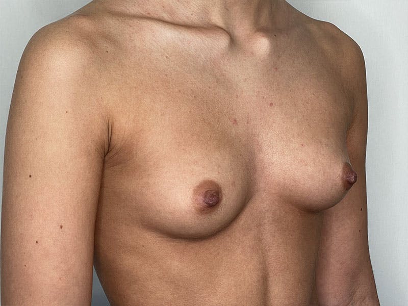 Breast Augmentation Before & After Gallery - Patient 122371058 - Image 3