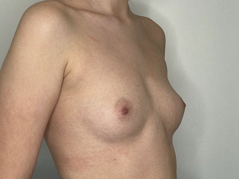 Before and after breast augmentation in Glasgow 3